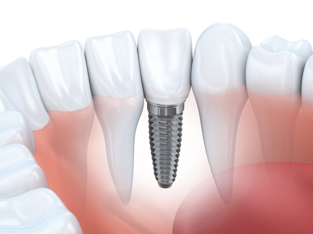 Dental Implants In Park City Featured Image - Park City Dental