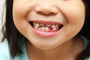 Tips To Prevent Premature Loss Of Baby Teeth Featured Image - Park City Dental