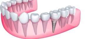 Tooth Replacement That's Better Than A Bridge Featured Image - Park City Dental